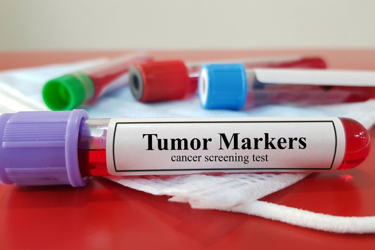 Lab Sample Tumor Markers Test