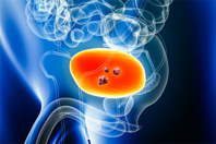 GettyImages-1467893023_bladder_cancer