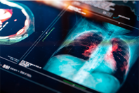 GettyImages-1299730658 lung cancer