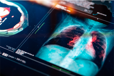 GettyImages-1299730658 lung cancer