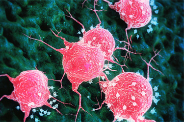 Tumor-cancer cell-GettyImages-1405940919 Tumor-cancer cell-GettyImages-1405940919