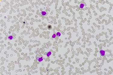 AML Acute myeloid leukemia-GettyImages-1337752576